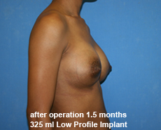 plastic-surgery-breast-augmentation
